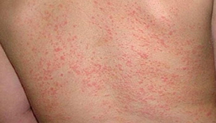 গরমে ঘামাচি ও চুলকানি থেকে মুক্তির উপায়